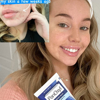 Antimicrobial Hydrating Acne Creamy Wash, 4% Benzoyl Peroxide by PanOxyl 170 G. Min. 10 per order